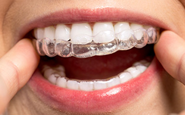 Invisalign Clear Aligners